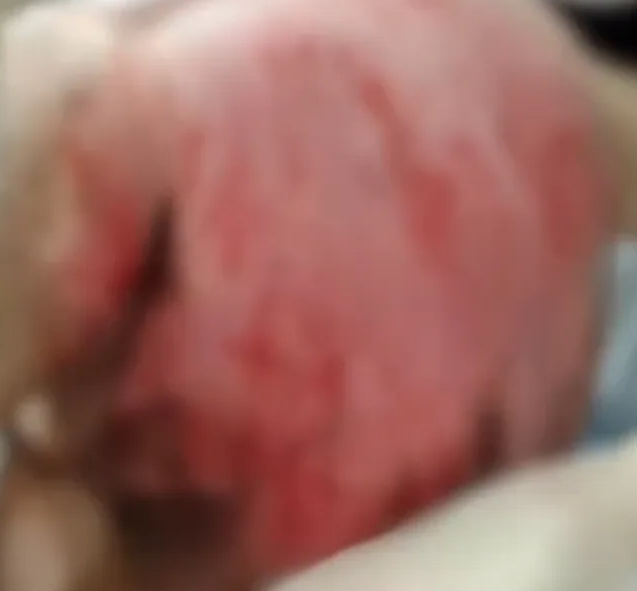 校園防欺凌報警：13歲男孩被8名同學霸凌，他們往他身上淋了11盆開水，9天后才被發現