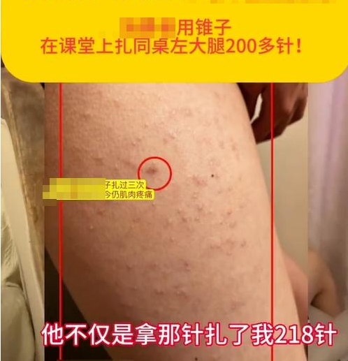 校園防欺凌報(bào)警器:“女生被同桌扎218針”,未達(dá)到校園霸凌標(biāo)準(zhǔn)?多方回應(yīng) 校園防欺凌報(bào)警器:“女生被同桌扎218針”,未達(dá)到校園霸凌標(biāo)準(zhǔn)?多方回應(yīng)